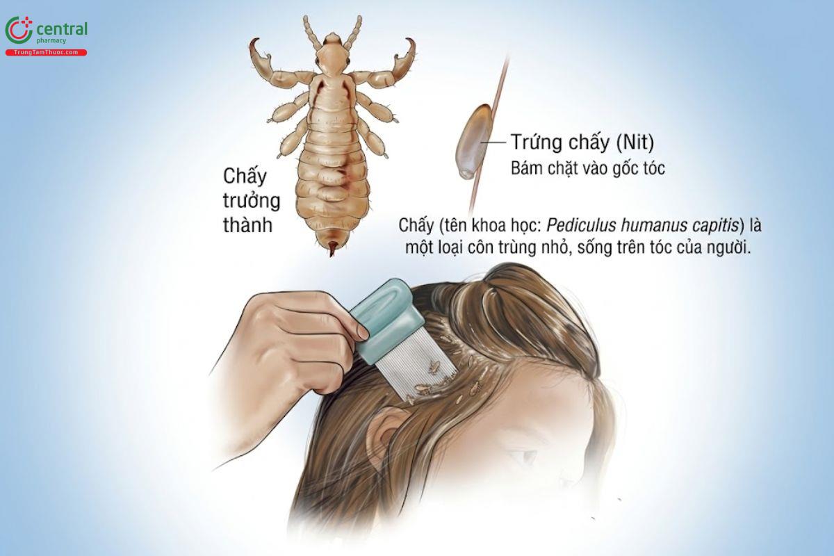 Chấy là gì?
