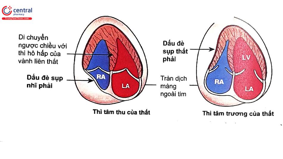 chèn ép tim cấp