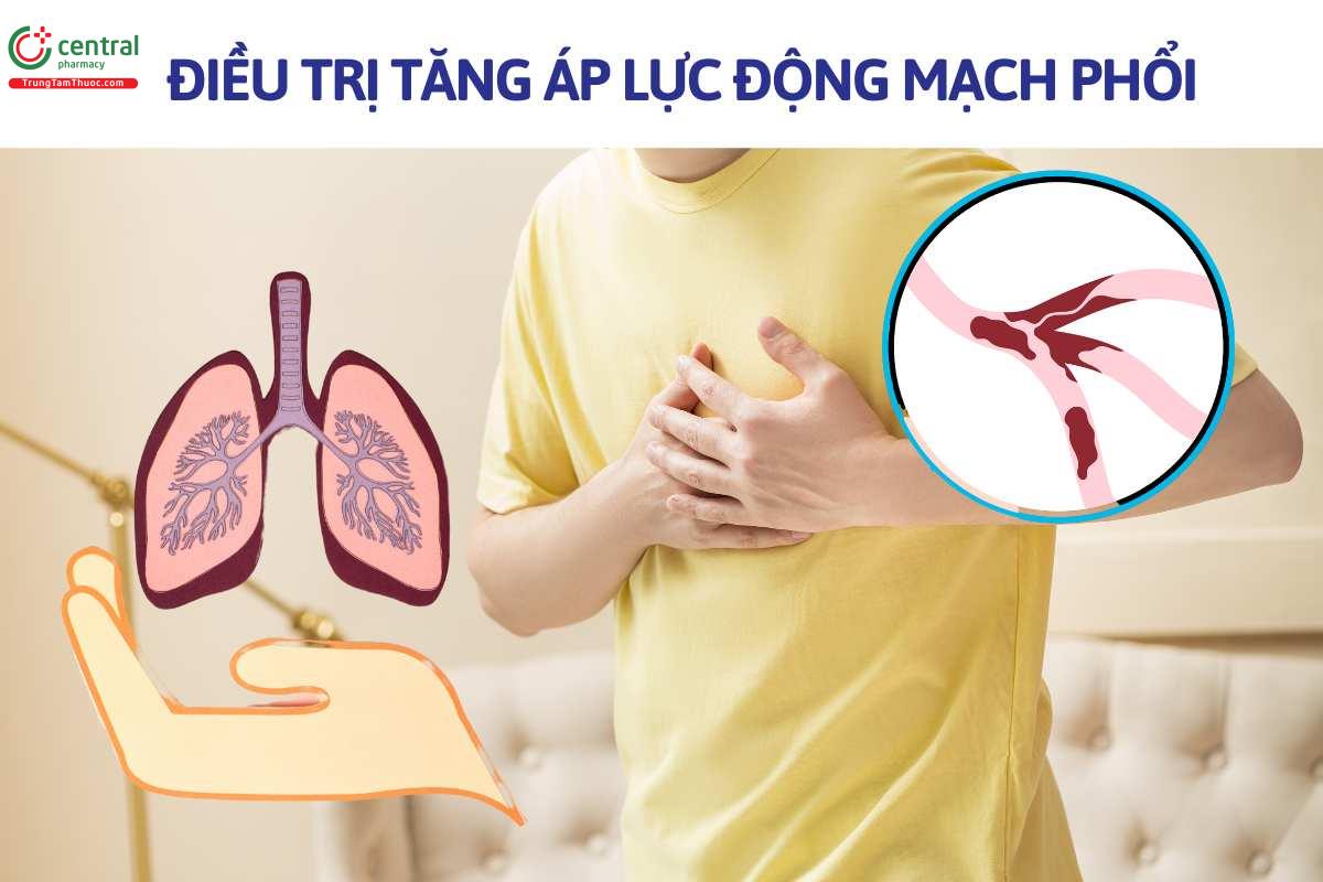 Chỉ định của Iloprost