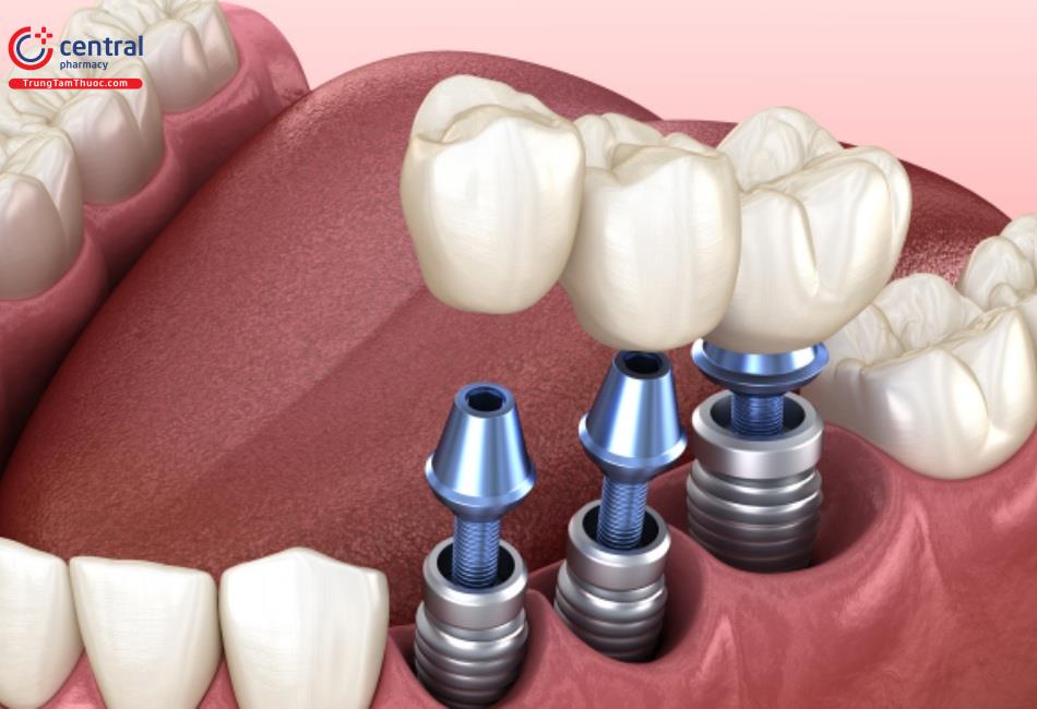 Chi phí trồng răng implant cao hơn so với các phương pháp khác