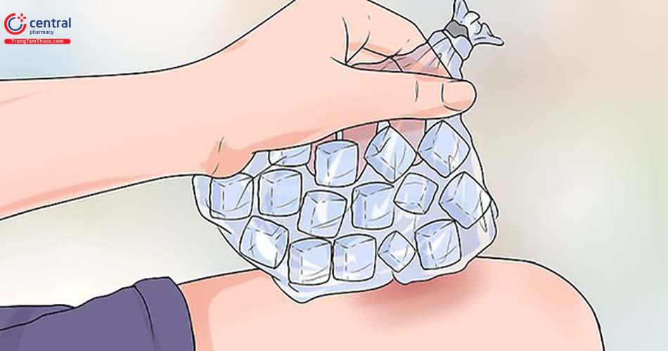 Chườm lạnh tại nhà giúp giảm cảm giác sưng đau, làm mờ vết máu bầm