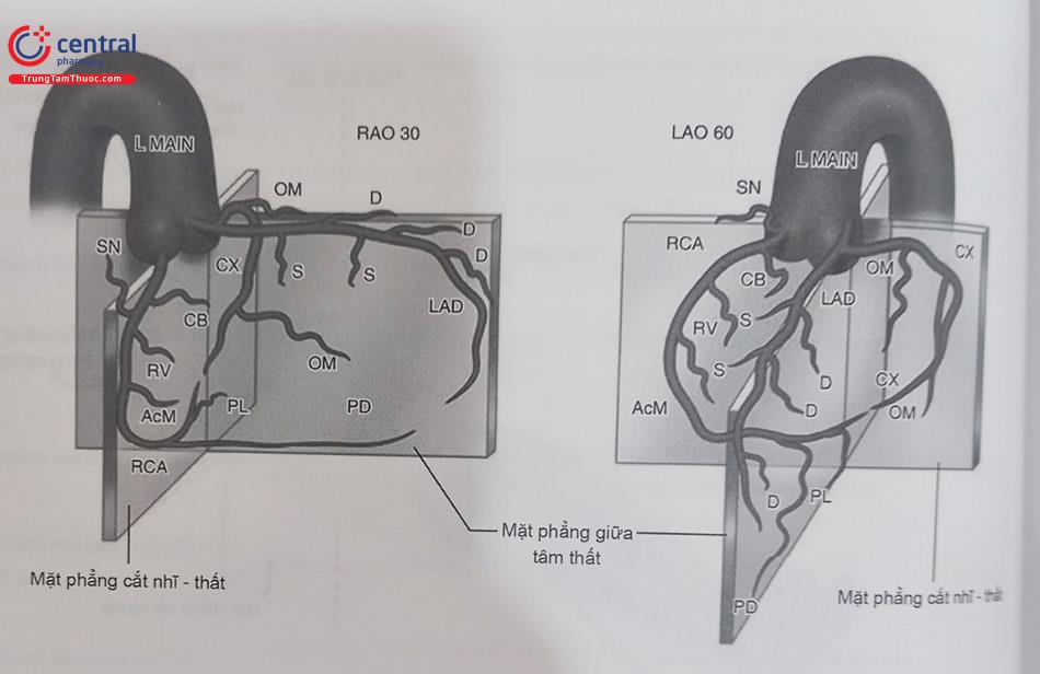 Hình 13.3. Sơ đồ các mặt phẳng góc chụp động mạch vành sẽ cho thấy các đoạn và hình ảnh của động mạch vành khác nhau. Hình bên trái là ở góc nghiêng phải 300 (RAO 300) và bên phải là góc chụp nghiêng trái 600 (RAO 600) khi chụp sẽ cho thấy hình ảnh của các nhánh ĐMV bên phải và trái khác nhau (nguồn Grossman’s cardiac catheterization, angiography, and intervention. 6th edition 2014).
