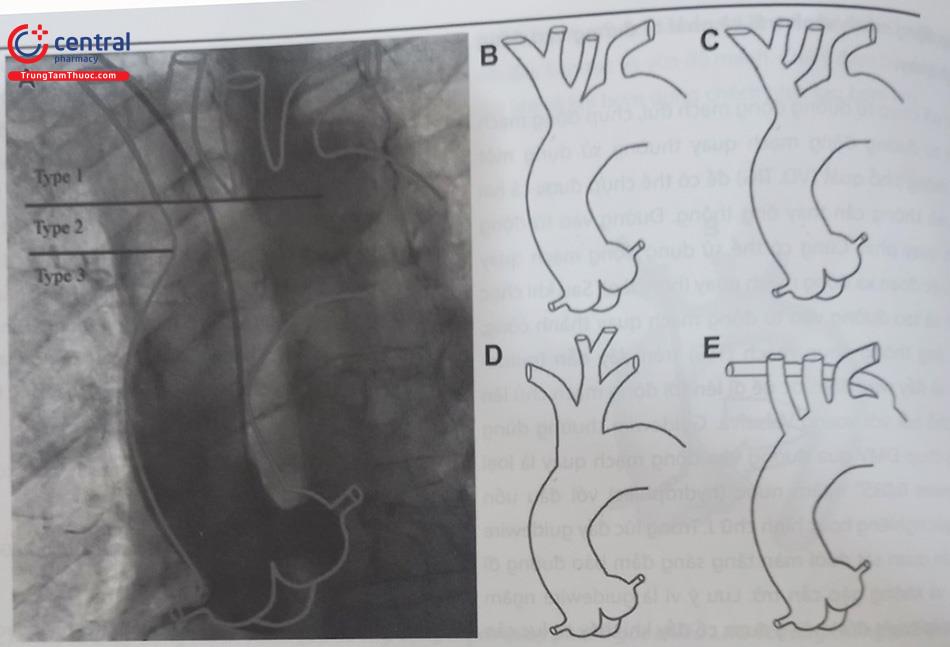 Hình 13.15. Một số hình thái của quai động mạch chủ và xuất phát của động mạch dưới đòn phải ảnh hưởng đến đường đi trong chụp động mạch vành qua đường động mạch quay.