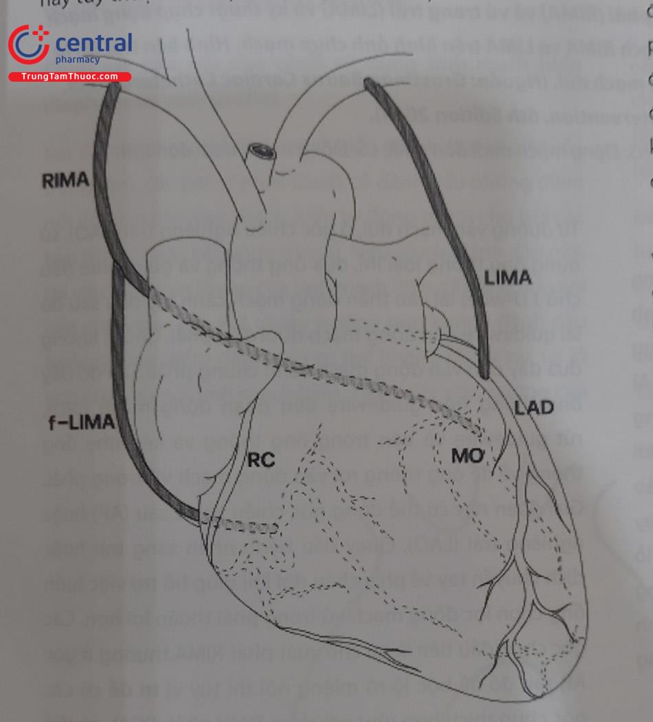 Hình 13.17. Hình ảnh cầu nối LIMA – RIMA