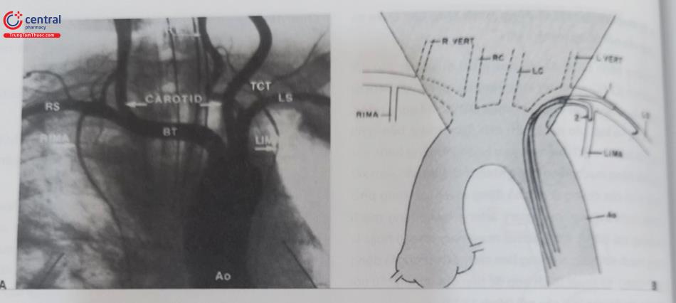 Hình 13.18. Hình ảnh các nhánh động mạch vú trong phải (RIMA) và vú trong trái (LIMA) và kỹ thuật chụp động mạch vú trong trái. Hình bên phải (A) là các nhánh động mạch RIMA và LIMA trên hình ảnh chụp mạch. Hình bên trái (B) là mô phỏng kỹ thuật chụp LIMA từ đường vào là động mạch đùi. (Nguồn: Grossman Bairns Cardiac Catheterization, Angiography and Intervention. 6th Edition 2014).