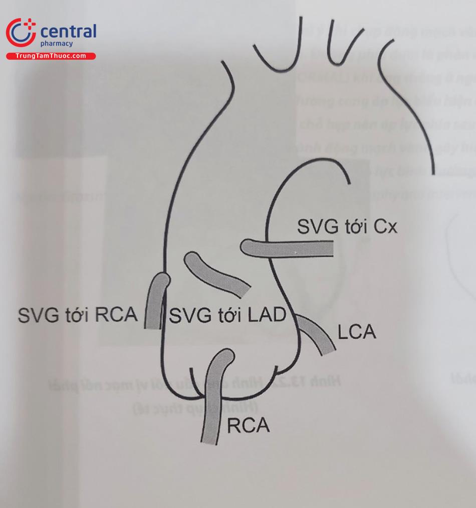 Hình 13.20. Hình ảnh vị trí các cầu nối tĩnh mạch hiển theo quy ước (ở góc chiếu nghiêng trái – LAO): từ trái sang phải theo hình vẽ (từ phải sang trái của người bệnh) cầu nối tĩnh mạch hiển (SVG) tới RCA, LAD, LCX.