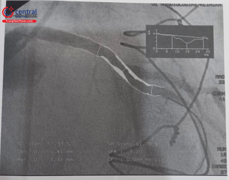 Hình 13.30. Một trường hợp sử dụng phần mềm QCA để tính toán các thông số liên quan đến tổn thương động mạch vành.