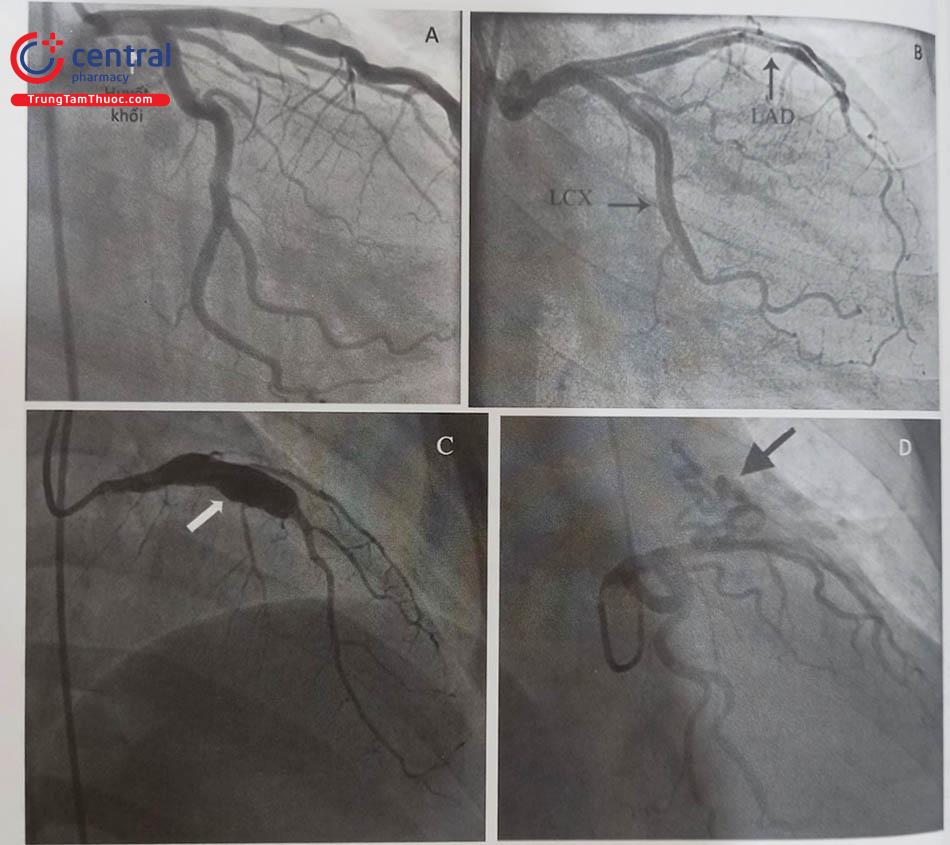 Hình 13.31. Một số chụp mạch bệnh lý khác thường thấy trong chụp mạch vành. (A) Hình ảnh huyết khối động mạch vành (mũi tên chỉ). (B) Hình ảnh lóc tách động mạch vành lan vào động mạch liên thất trước và động mạch mũ (mũi tên chỉ). (C) Hình ảnh phình giãn động mạch liên thất trước (mũi tên chỉ). (D) Hình ảnh rò động mạch vành vào động mạch phổi (mũi tên chỉ).