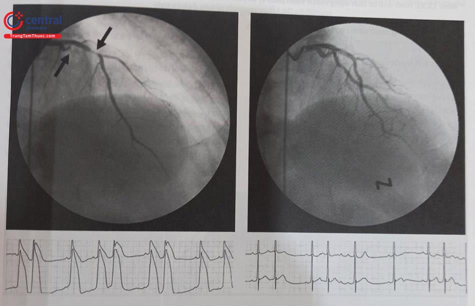 Hình 13.32. Hình ảnh co thắt động mạch liên thất trước. Vị trí co thắt (mũi tên chỉ hình bên trái) được giải quyết sau khi đã bơm nitroglycerin trong lòng mạch (hình bên phải)
