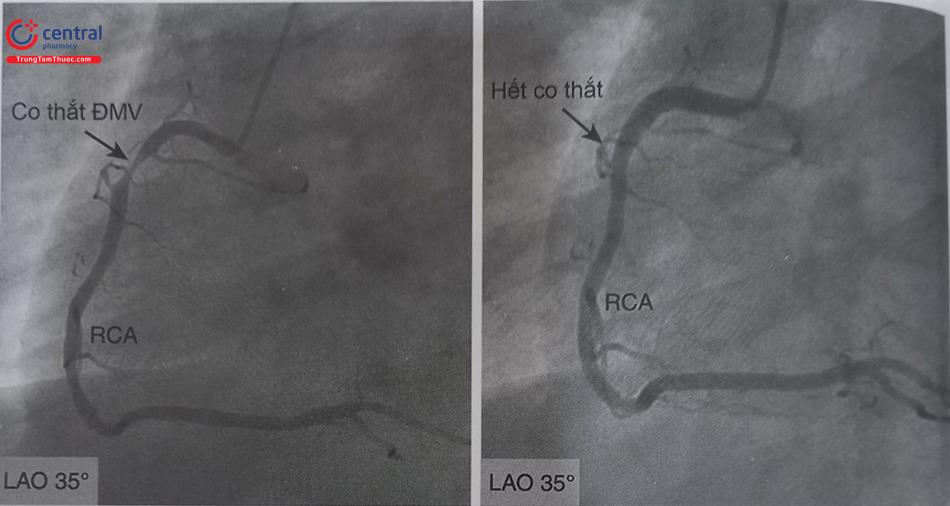 Hình 13.33. Hình ảnh co thắt động mạch vành phải vị trí mũi tên chỉ ở hình bên trái và được giải quyết sau khi bơm nitroglycerin trong lòng mạch (hình bên phải)