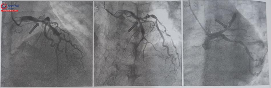 Hình 13.34. Hình ảnh chồng hình với một tổn thương động mạch liên thất trước (mũi tên chỉ). Với góc chụp RAO-CRA (hình bên trái) và LAO-CRA (giữa) không cho phép đánh giá rõ tổn thương, trong khi với góc chụp LAO-CAU (spider view) hình bên phải, cho phép đánh giá rõ tổn thương nhất. (Mũi tên chỉ vào vị trí tổn thương động mạch vành)