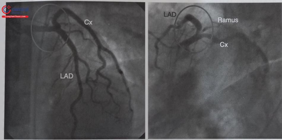 Hình 13.35. Hình ảnh chồng hình tổn thương tại lỗ động mạch liên thất trước và nhánh Ramus (nhánh giữa). Hình bên trái (LAO-CRA) không nhìn rõ khu vực tổn thương do sự chồng lấp hình; hình bên phải (LAO-CAU) cho phép nhìn rõ chỗ chia nhánh và tổn thương tại lỗ LAD và Ramus.