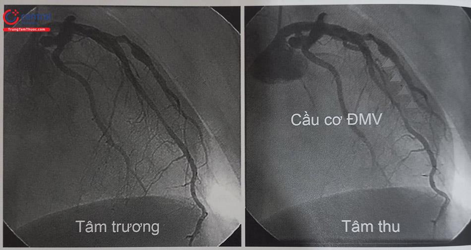 Hình 13.37. Hình ảnh cầu cơ động mạch vành (LAD) trên phim chụp mạch. Bên trái là hình ảnh trong thời kỳ tâm trương, bên phải là hình ảnh trong kỳ tâm thu, đoạn các đầu mũi tên chỉ là đoạn cầu cơ động mạch vành gây hình ảnh hẹp đáng kể LAD.