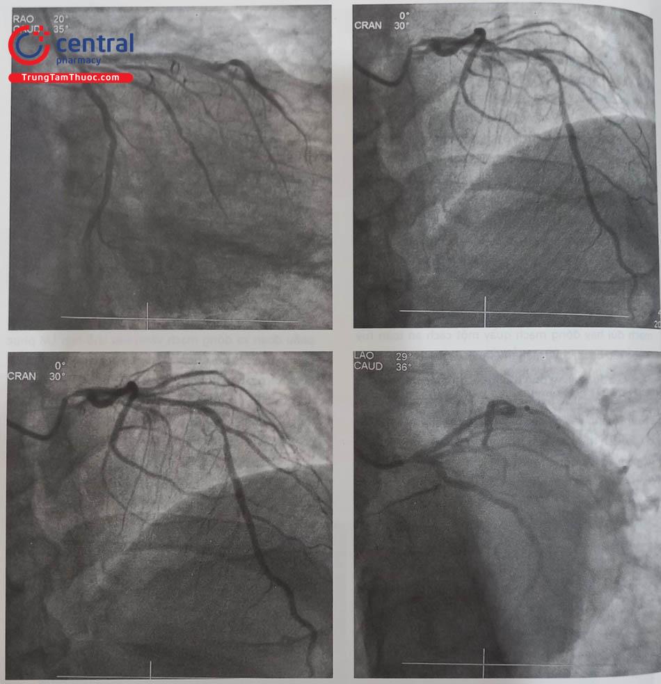 Hình 13.38. Hình ảnh hẹp khít lỗ vào thân chung động mạch vành trái ở một người bệnh. Với góc chếch đầu (CRAN) không nghiêng (hình dưới bên trái) cho phép quan sát rõ hẹp lỗ vào LM và và đoạn sau LAD.