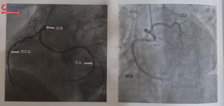Hình 13.40. Hình ảnh hai trường hợp động mạch mũ xuất phát từ động mạch vành phải. Hình trái: LCX xuất phát từ ĐMV phải. Hình phải: LCX xuất phát từ vị trí nhánh nón.