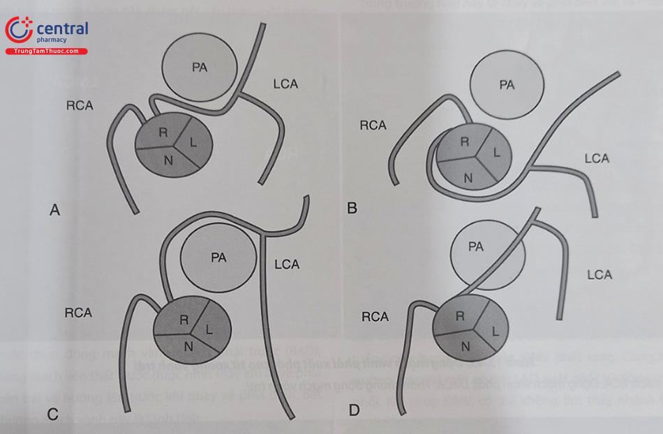Hình 13.41. Hình ảnh động mạch vành trái xuất phát từ xoang vành phải. (A) Động mạch vành trái đi giữa 2 đại động mạch; (B) Động mạch vành trái đi vòng (quặt) lại qua động mạch chủ; (C) Động mạch vành đi trước động mạch phổi; (D) Động mạch vành qua vách tim. LCA: ĐMV trái, RCA: ĐMV phải; PA: động mạch phổi; R: xoang vành phải; L: xoang vành trái; N: xoang không vành