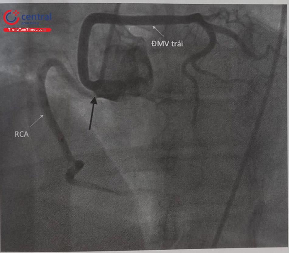 Hình 13.42. Hình ảnh động mạch vành trái xuất phát từ xoang vành phải chạy vòng sau động mạch chủ. Mũi tên đen chỉ gốc chung của động mạch vành phải (RCA) và động mạch vành trái.
