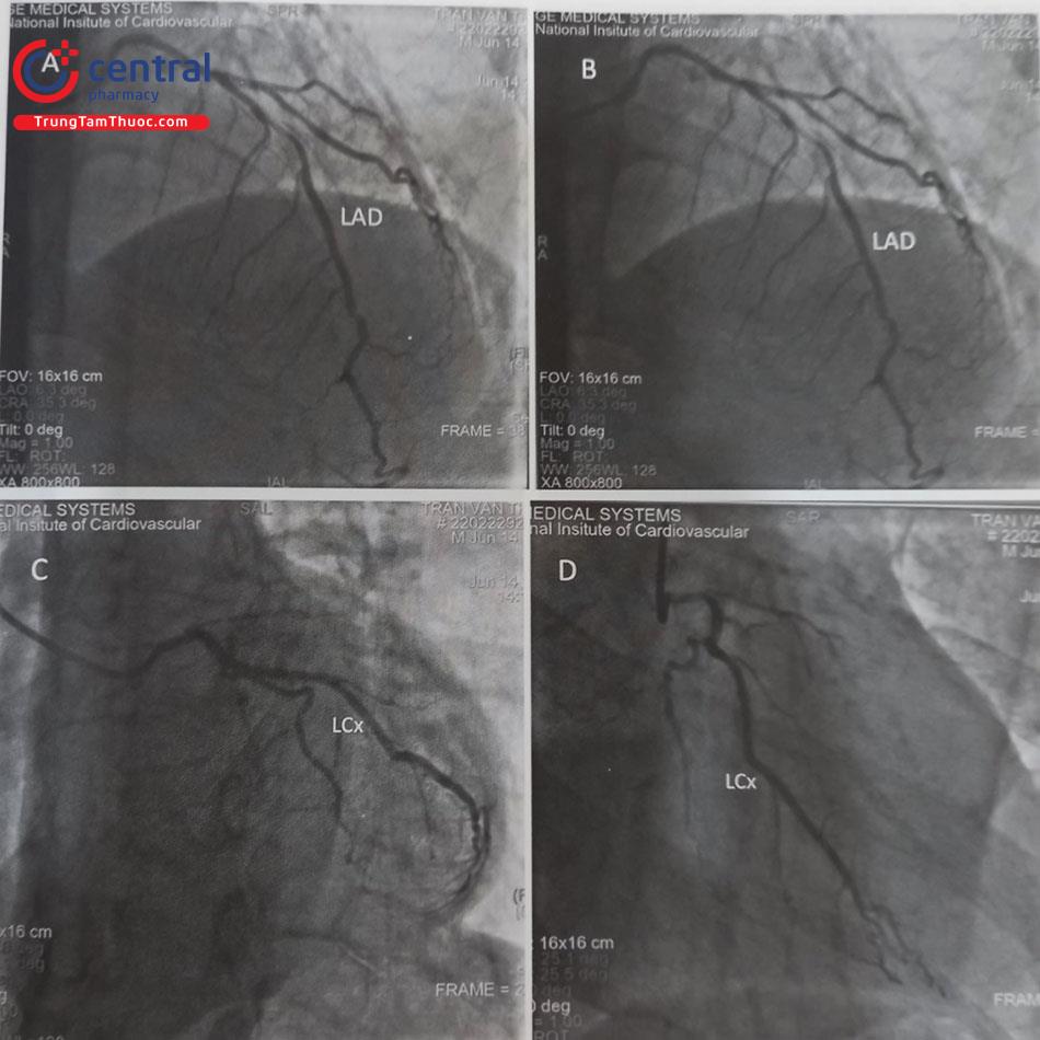 Hình 13.46. Hình ảnh không có thân chung động mạch vành trái. Động mạch liên thất trước (A,B) và Động mạch mũ (C,D) xuất phát từ 2 lỗ riêng biệt với các góc chụp khác nhau.