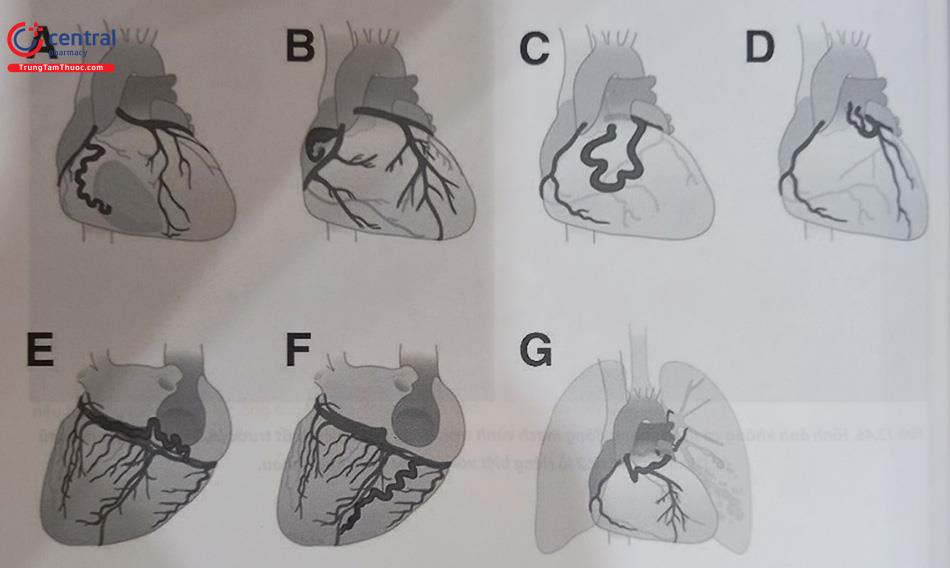 Hình 13.47. Phân loại CAFs dựa trên vị trí đổ vào. (A) Rò vào thất phải;B, rò vào nhĩ phải; C, rò vào động mạch phổi một nhánh đơn độc; D, rò vào động mạch phổi với nhiều nhánh con; E, rò vào xoang vành; F, rò vào tĩnh mạch vành và G, Rò vào động mạch phế quản. (Nguồn: Luo L, Kebede S, Wu S, Stouffer GA. Coronary artery fistulae. Am J Med Sci 2006).