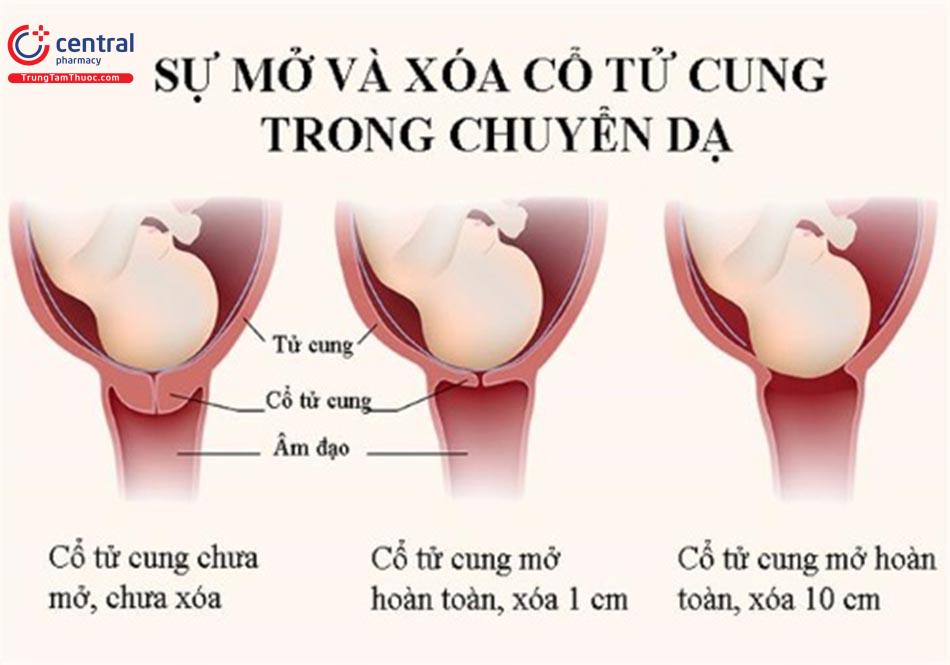 Cổ tử cung thay đổi trong quá trình chuyển dạ