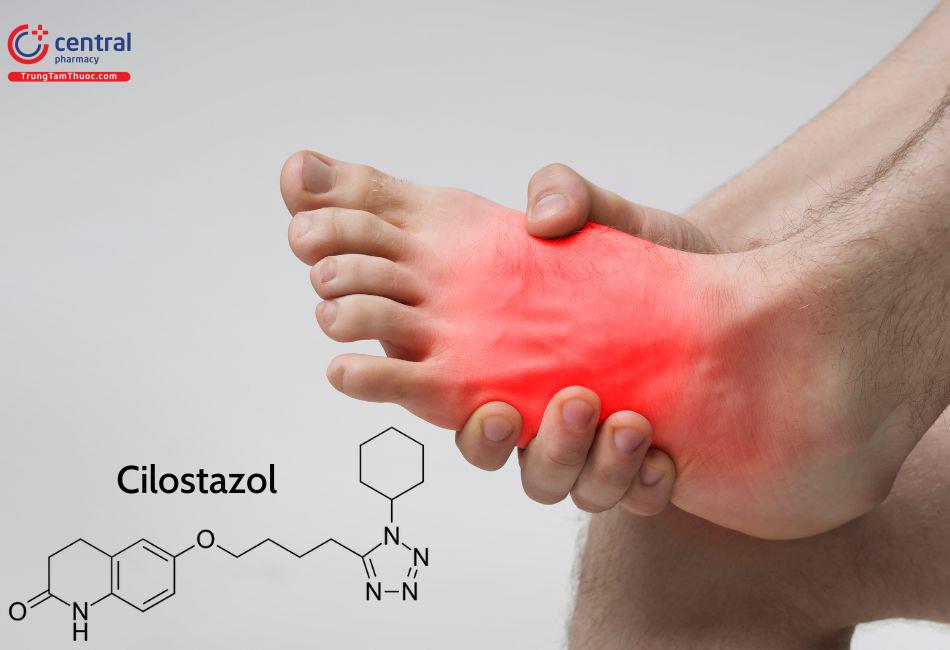 Cilostazol giảm đau cách hồi