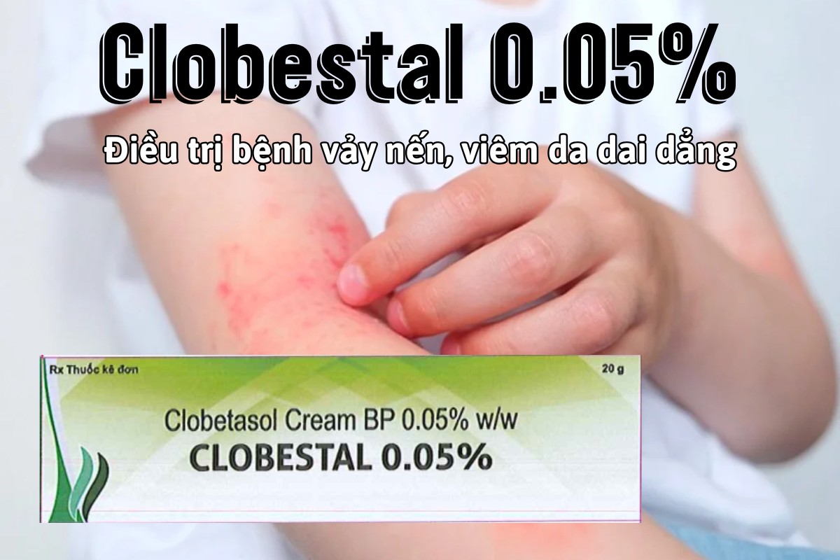 Thuốc Clobestal 0.05% điều trị bệnh vảy nến và viêm da dai dẳng, khó chữa