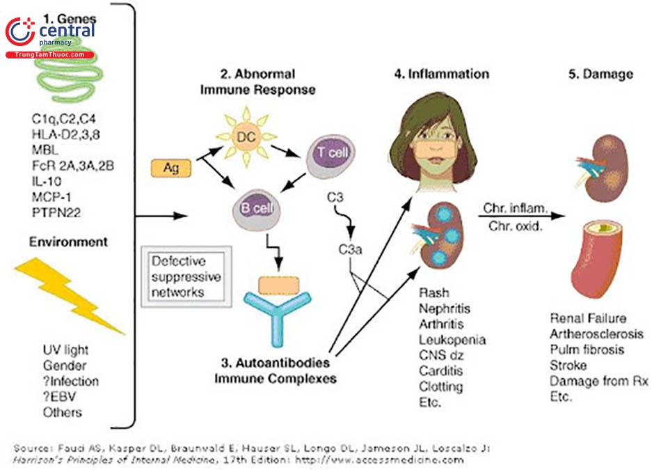 Cơ chế bệnh sinh của bệnh Lupus ban đỏ