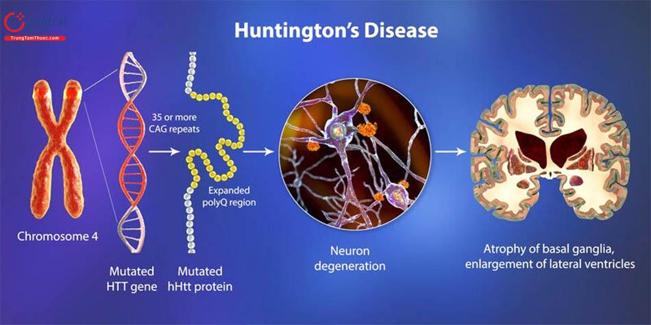 Hình 4: Bệnh Huntington