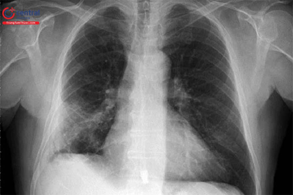 Hình ảnh X-quang ngực phổi của bệnh nhân suy hô hấp do Covid-19