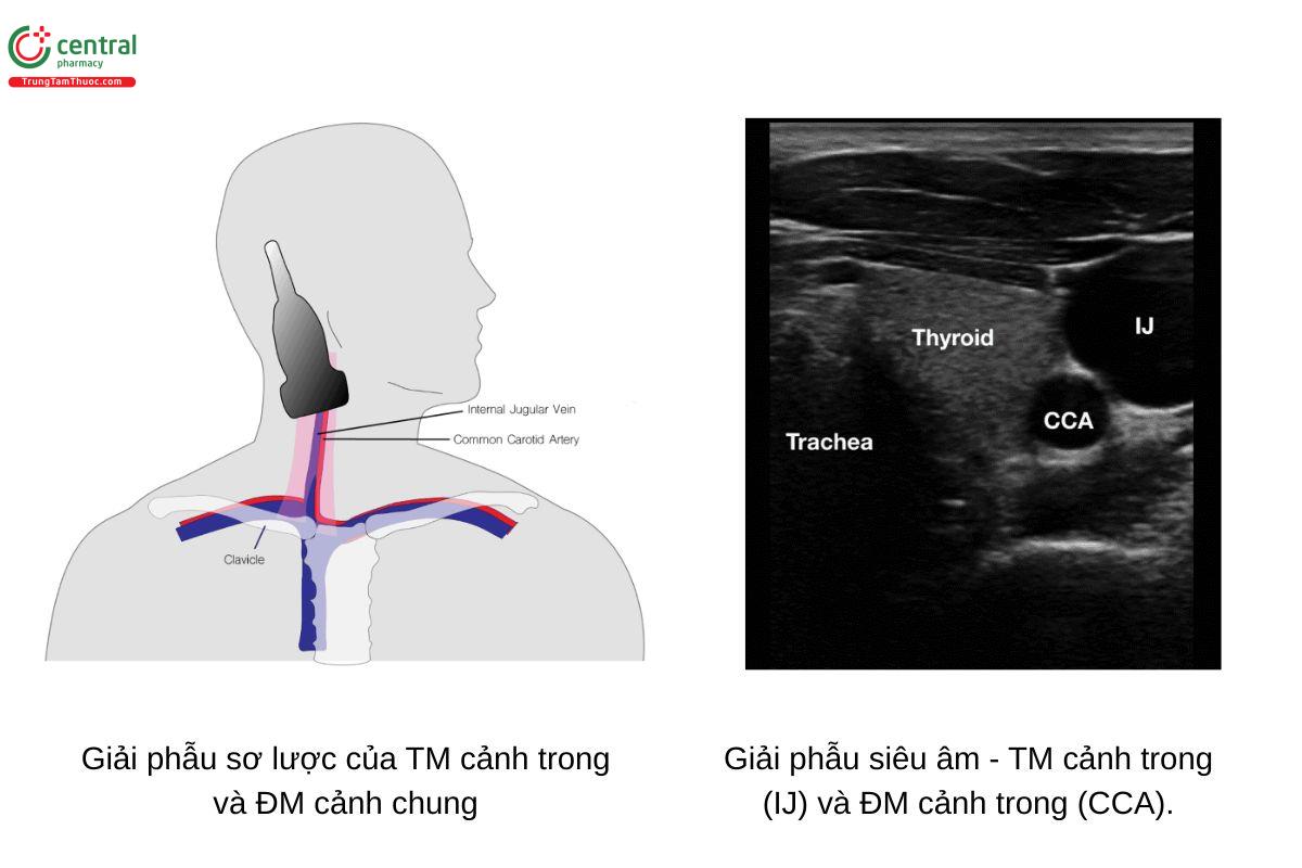 Giải phẫu sơ lược và siêu âm của TM cảnh trong và ĐM cảnh.