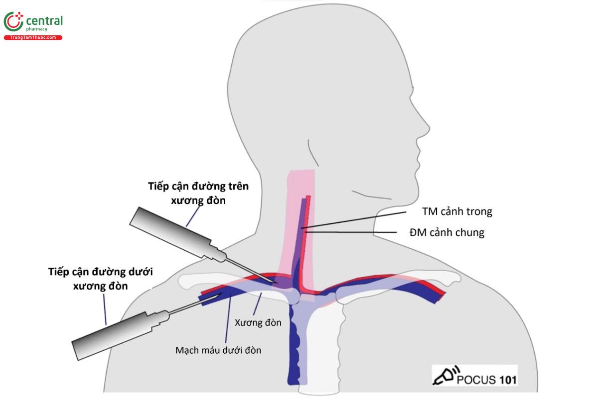 Tiếp cận đường dưới đòn và đường trên đòn