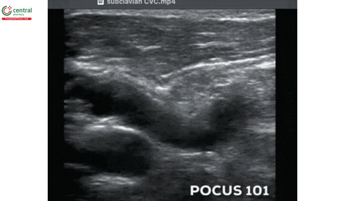 Quá trình đâm kim vào TM dưới đòn trên mặt cắt dọc bằng đường tiếp cận dưới xương đòn