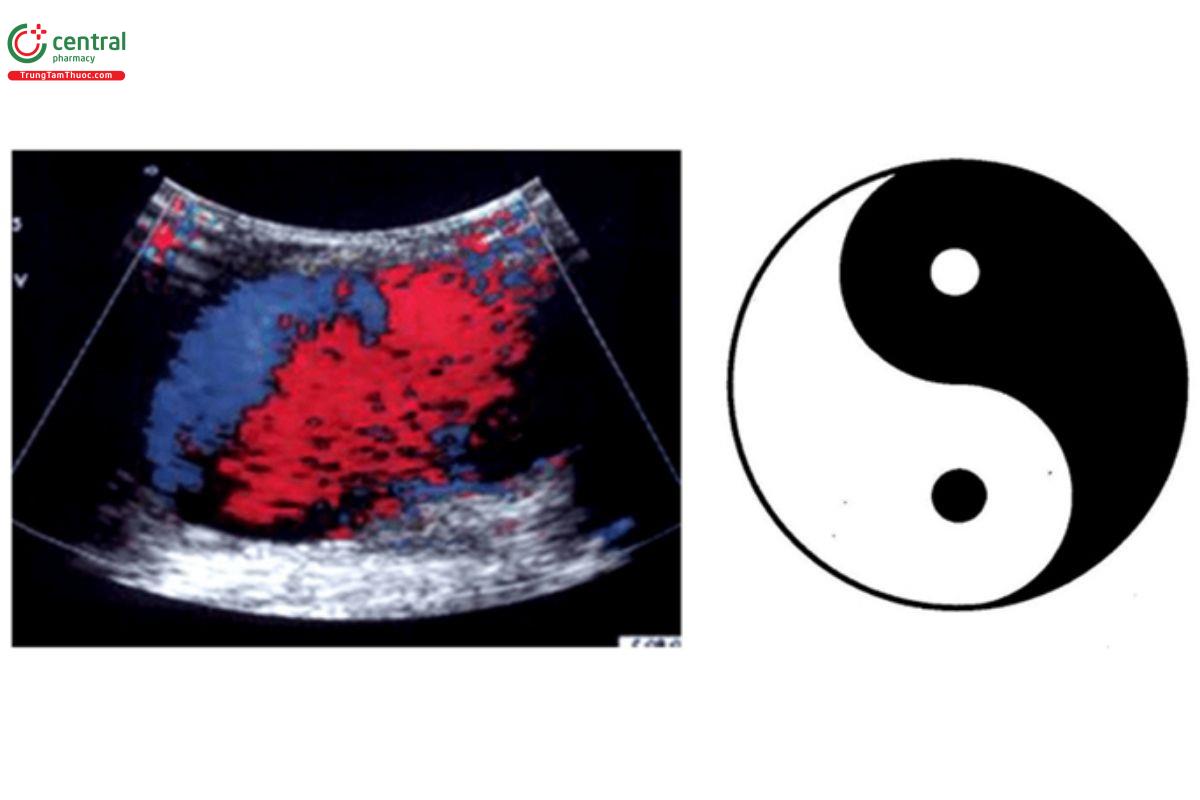 Dấu "Âm - Dương" (Yin Yang Sign) - Giả phình mạch