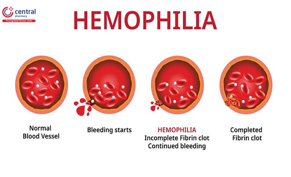 Điều trị bệnh Hemophilia