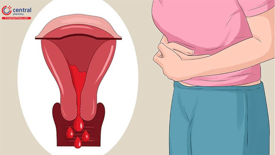 Điều trị lạc nội mạc tử cung như thế nào?