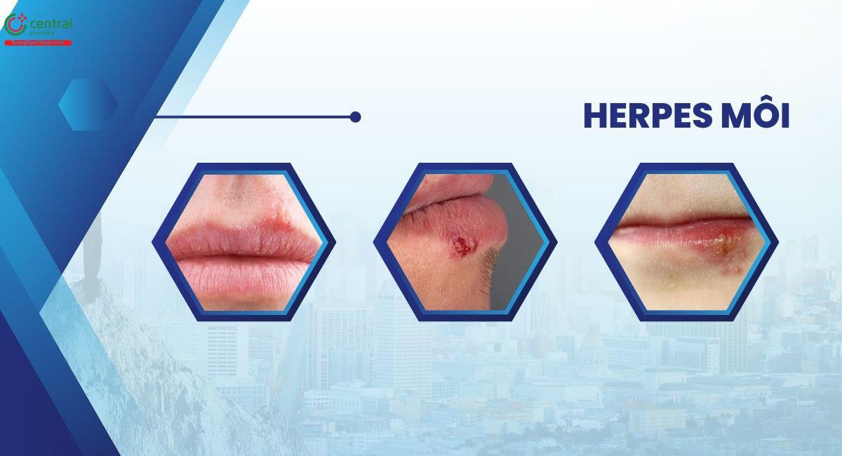 Herpes môi