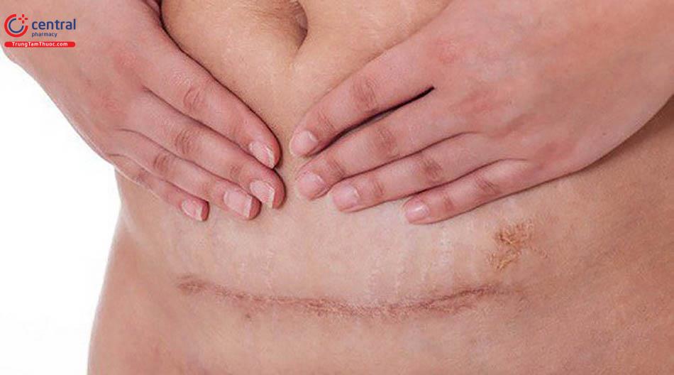 Đường mổ dài khi phẫu thuật
