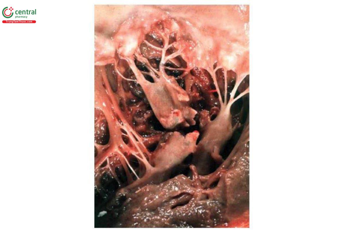Hình 5. Đứt hoàn toàn cơ nhú sau do NMCT thành dưới.