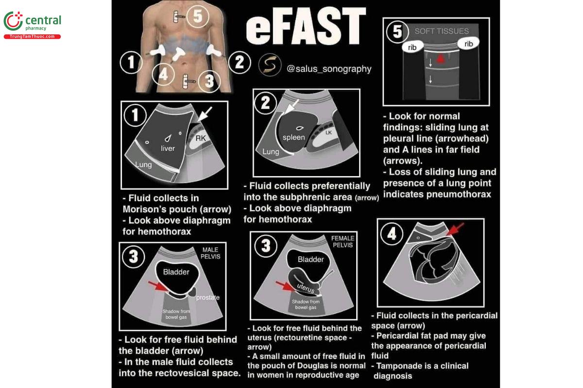 “ FAST exam” hoặc Siêu âm bụng có trọng điểm trong chấn thương