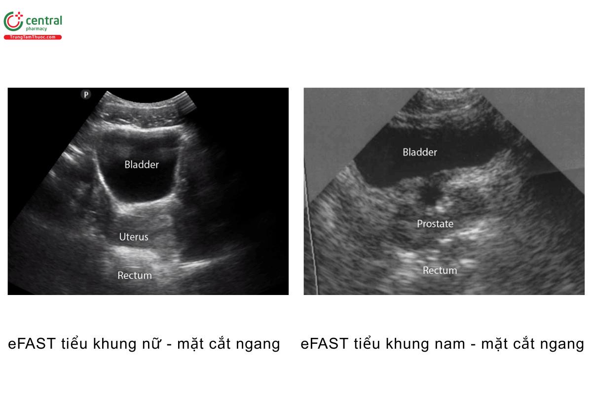 eFAST tiểu khung nữ - mặt cắt ngang, eFAST tiểu khung nam - mặt cắt ngang
