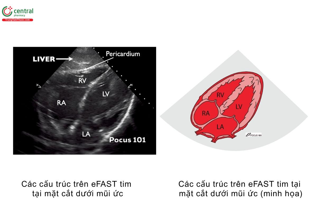 Các cấu trúc trên eFAST tim tại mặt cắt dưới mũi ức, các cấu trúc trên eFAST tim tại mặt cắt dưới mũi ức (minh họa)