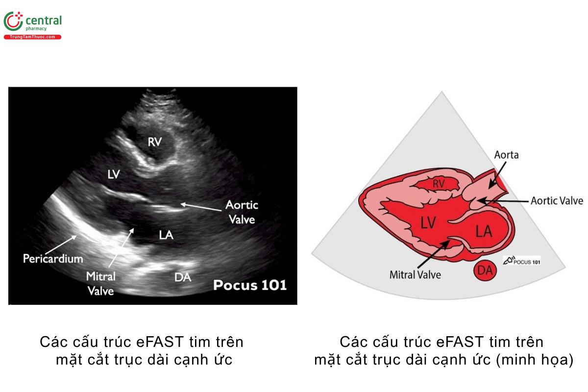 Các cấu trúc eFAST tim trên mặt cắt trục dài cạnh ức, các cấu trúc eFAST tim trên mặt cắt trục dài cạnh ức (minh họa)