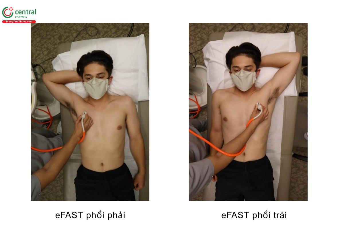 eFAST phổi phải, eFAST phổi trái