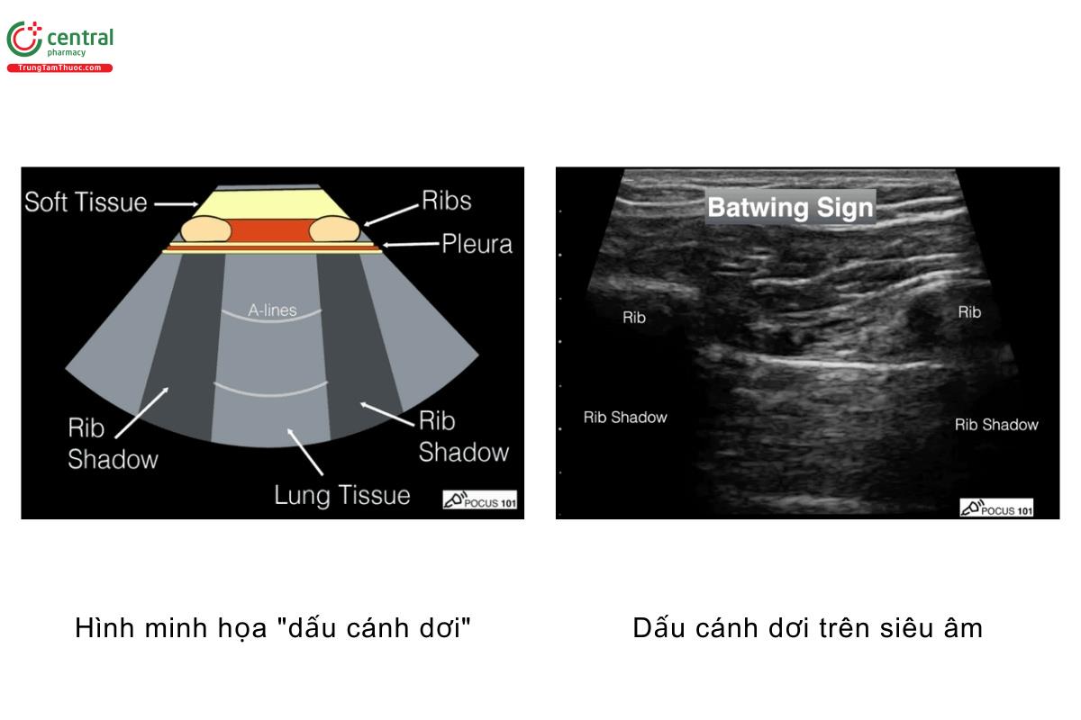 Hình minh họa "dấu cánh dơi", dấu cánh dơi trên siêu âm