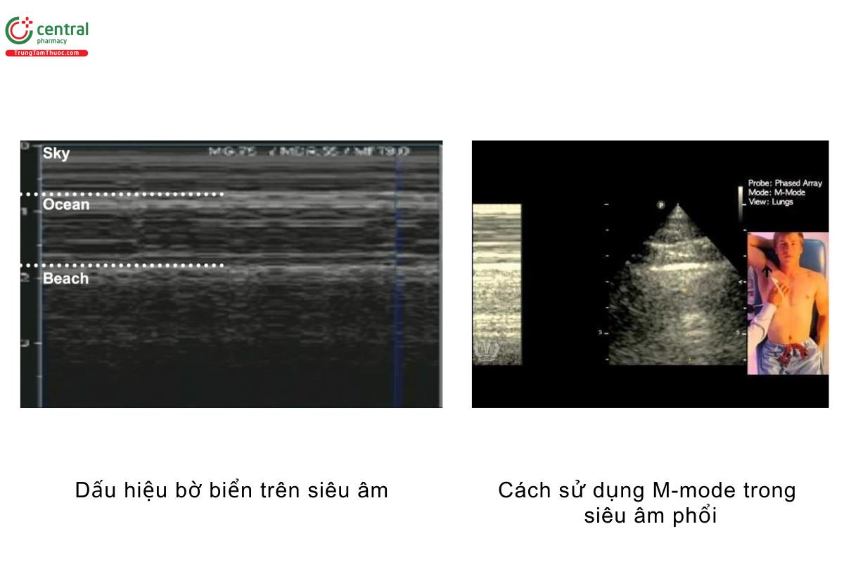 Dấu hiệu bờ biển trên siêu âm, cách sử dụng M-mode trong siêu âm phổi