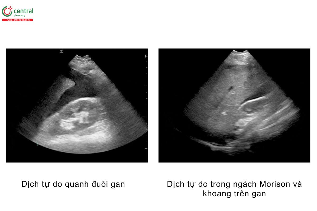 Dịch tự do quanh đuôi gan, dịch tự do trong ngách Morison và khoang trên gan