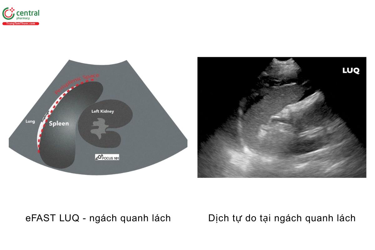 eFAST LUQ - ngách quanh lách, dịch tự do tại ngách quanh lách