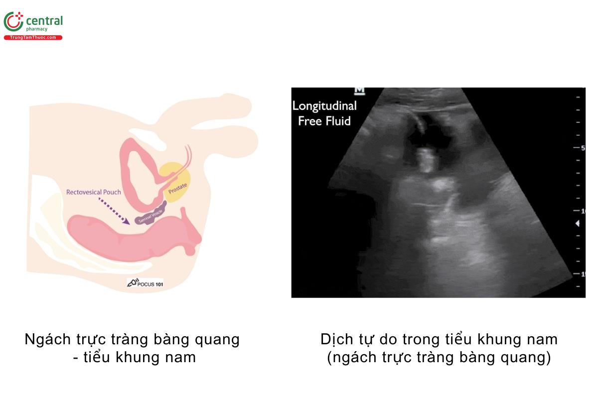 Ngách trực tràng bàng quang - tiểu khung nam, dịch tự do trong tiểu khung nam (ngách trực tràng bàng quang)