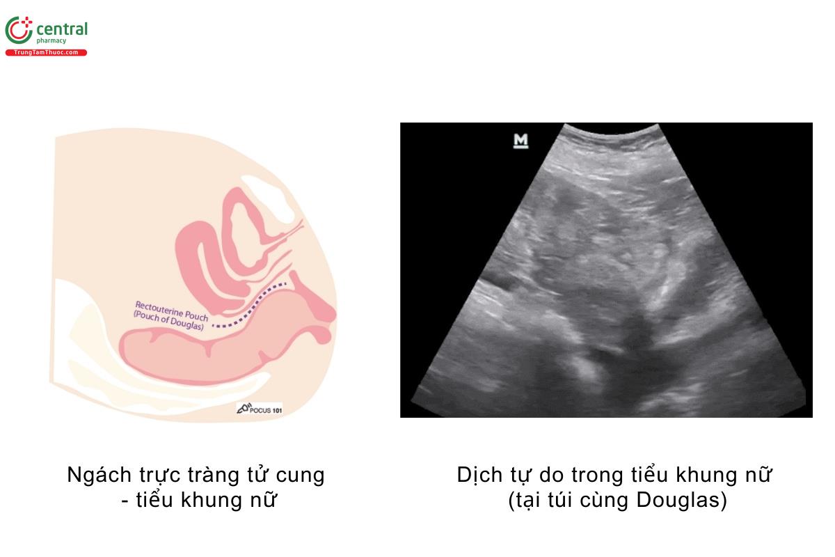 Ngách trực tràng tử cung - tiểu khung nữ, dịch tự do trong tiểu khung nữ (tại túi cùng Douglas)