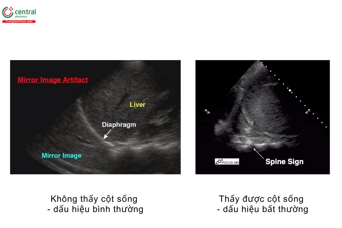 Không thấy cột sống - dấu hiệu bình thường, thấy được cột sống - dấu hiệu bất thường